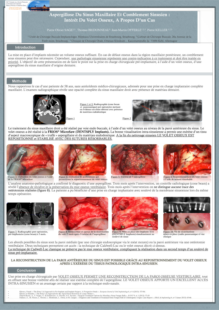 thumbnail of Aspergillose du Sinus Maxillaire